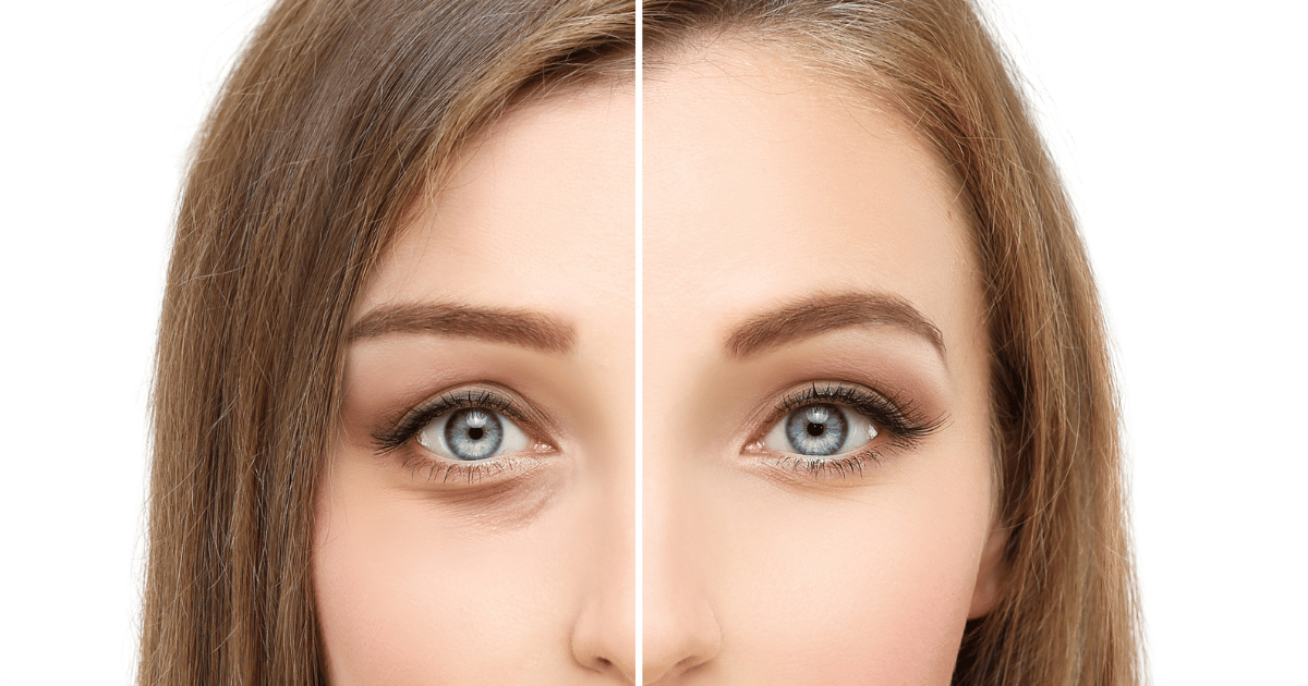 Blepharoplasty: The Ultimate Eyelid Surgery for a Refreshed Look