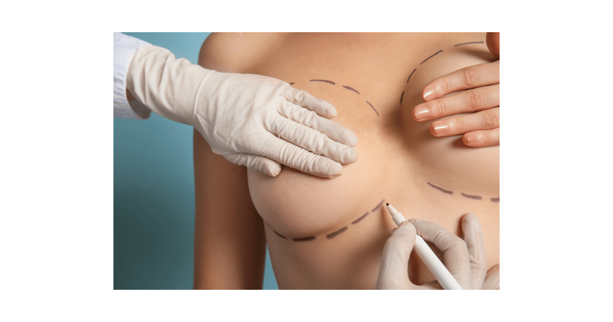 What You Need to Know About Mastopexy and Breast Lift Surgery
